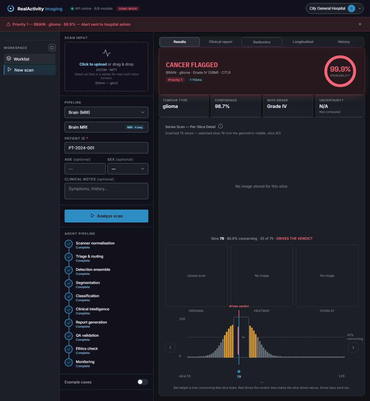 RealActivity Imaging dashboard showing a brain MRI series flagged Priority 1, glioma, Grade IV, 99.9% probability, with a per-slice concern chart showing which slice drove the verdict